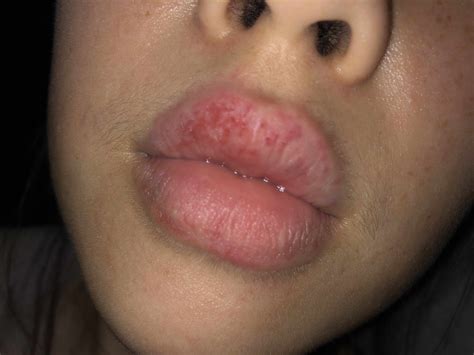 How To Heal A Rash On Your Lips