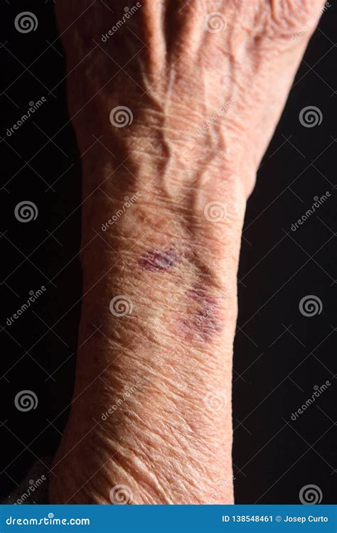 Close Up Of A Bruise In The Arm Of Senior Woman Stock Image Image Of