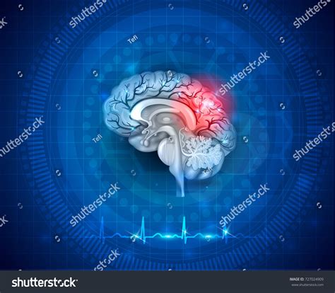 Human Brain Damage Treatment Concept 3d Stock Vector Royalty Free
