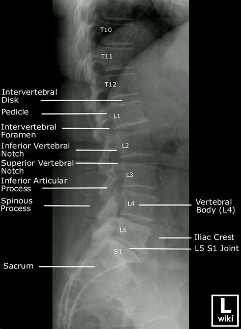 X Ray Of The Lower Back Showing Vertebrae Radiology Schools Radiology