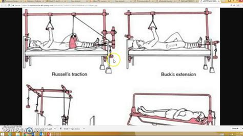 Buck traction information including symptoms, causes, diseases, symptoms, treatments, and other these medical condition or symptom topics may be relevant to medical information for buck traction Bucks Vs Russells Traction - How To Get Free V Bucks On Nintendo Switch