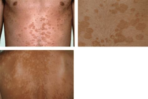 11 Tinea Versicolor Showing Hyperpigmented Lesions Upper Photos And