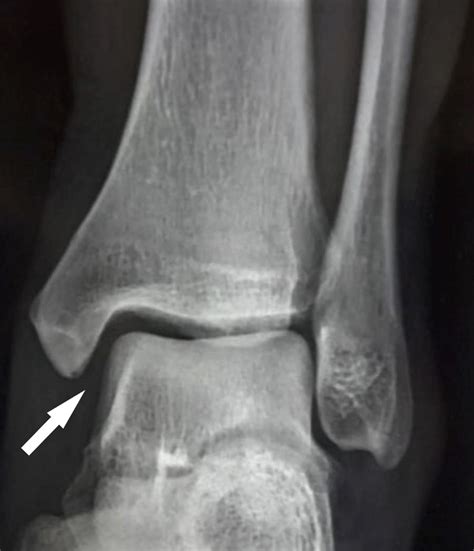 Cureus Isolated Posterior Malleolar Fracture A Case Report Of A Rare Presentation With