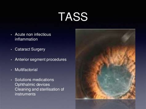 Causes Of Toxic Anterior Segment Syndrome