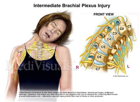 Understanding The Brachial Plexus Injury Part 1 Medivisuals Inc