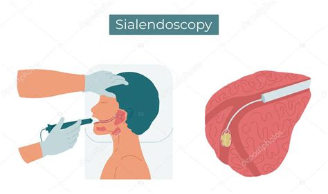 Ilustración Plana Vectorial De La Endoscopia Lateral Cirugía Para