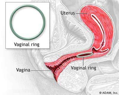 The New York Times Health Image Vaginal Ring