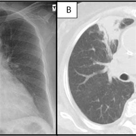A Chest Radiograph Showing Bilateral Diffuse Infiltrates B