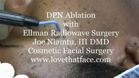 Dpn Removal With Ellman Radiowave Surgery By Dr Joe Niamtu Youtube