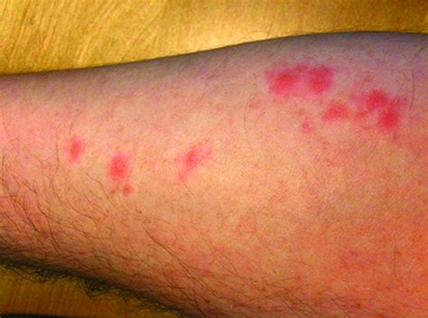 Bed Bug Rash Pictures Medical Pictures And Images 2021 Updated