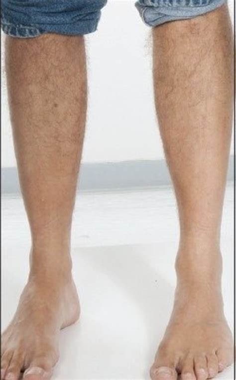 Leg Hair Loss In Men Its Not Uncommon Hubpages
