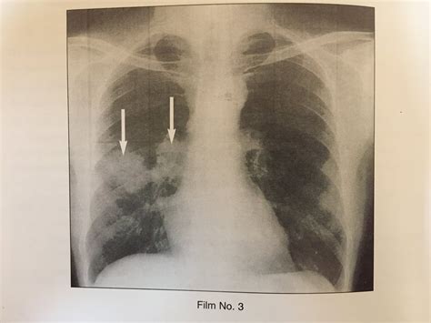 Tuberculosis On X Ray