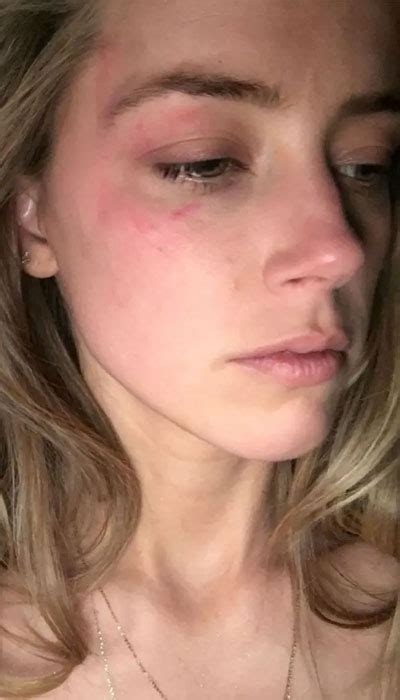 Amber Heards Attorneys Release Photos Of Her Bruised Face After Johnny Depp Hit Her With Phone