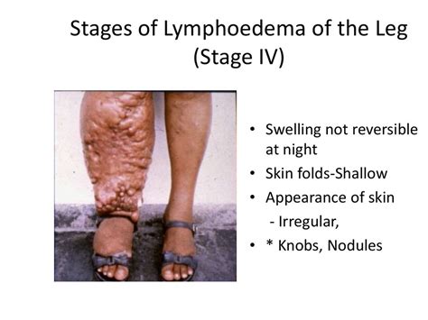 Different Stages Of Lymphoedema Lymphedema Lymphoedema Lymphedema Leg