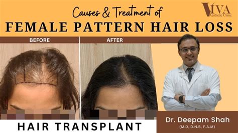 Female Pattern Hair Loss Causes And Treatment By Dr Deepam Shah Viva Aesthetic Clinic