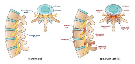 Spinal Stenosis Definition Causes Symptoms Diagnosis And Treatment