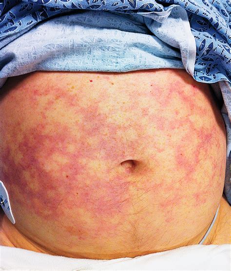Case Challenge — A 59 Year Old Man With Fever Confusion