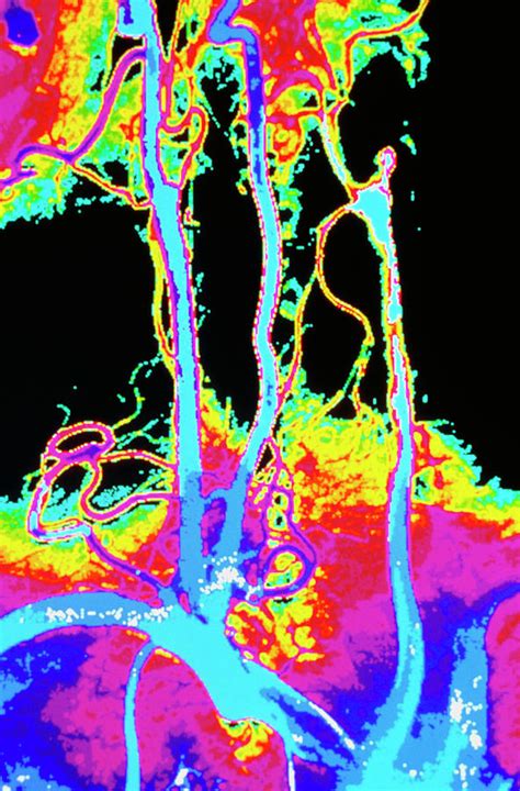 Colour Angiogram Of Arteries In The Human Neck Photograph By Gca