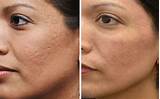 Acne Scar Laser Treatment Nyc Pictures