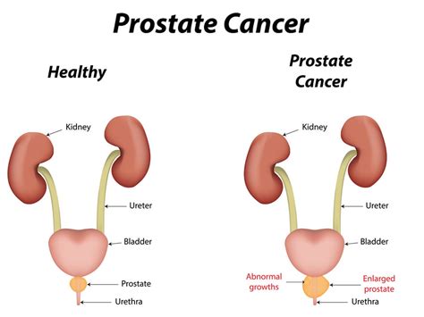Young Men Also Vulnerable To Prostate Cancer Healthtimes