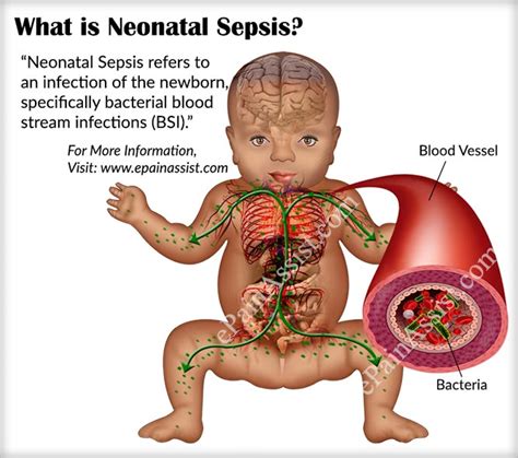 Sepsis happens when an infection you already have triggers a chain reaction throughout your body. Neonatal Sepsis: How Common is it and What is its Treatment?
