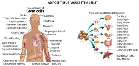 Stem Cell Therapy — Holland Stem Cells