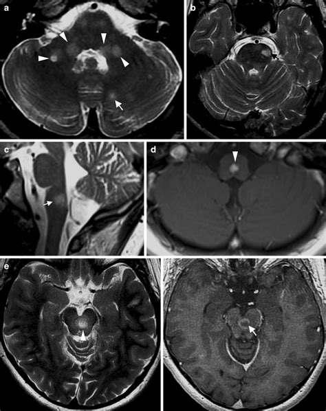 Infratentorial Lesions In Pediatric Onset Multiple Sclerosis A And