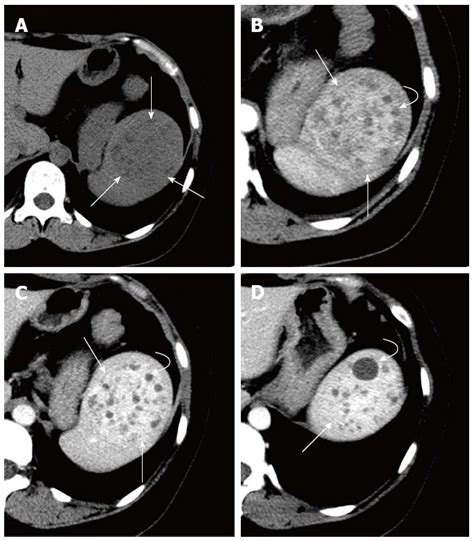 Splenic Lymphangioma That Manifested As A Solid Cystic Mass A Case Report
