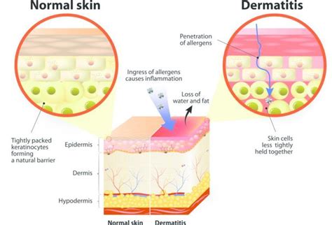Dermatitis Symptoms Causes Treatment And Diagnosis Findatopdoc