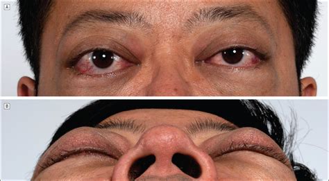 Intractable Graves Ophthalmopathy—quiz Case Endocrinology Jama