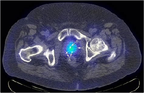 Arrow A Points To Fiducial Markers For External Beam Radiotherapy Image