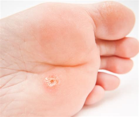 How To Prevent And Treat Feet Corns Calluses And Cracked Heels