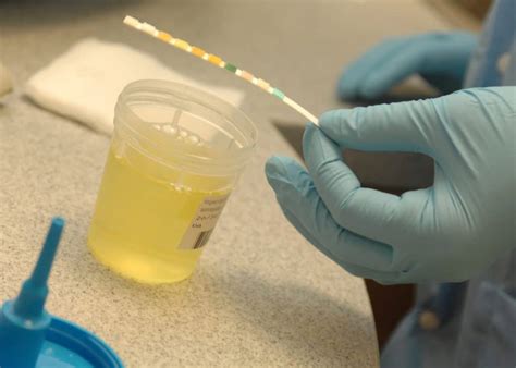 Find out how to prepare for the. Urine Dipstick Urinalysis | almostadoctor