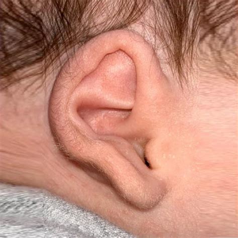 Earlobe Deformitie Dr Onganlar Baby Ear Molding