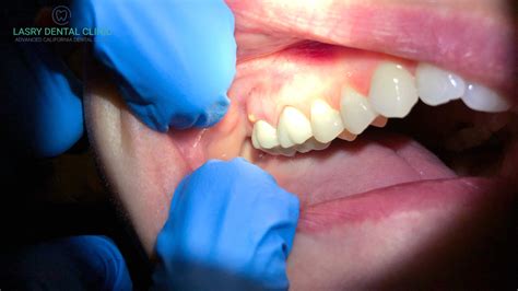 Abscessed Tooth Cause Treatment And At Home Remedies