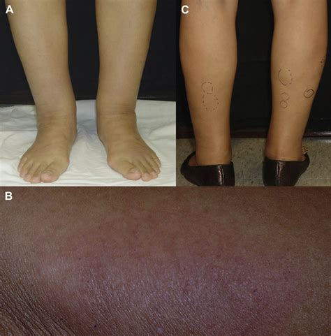 A Initial Edema And Ankle Swelling On Both Lower Legs B Indurated
