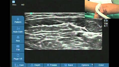 Ultrasound Location Of Lateral Cutaneous Nerve Of Forearm Youtube