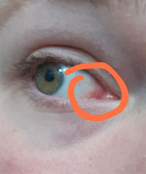 What Is This Redness In The Corner Of My Eye Roptometry