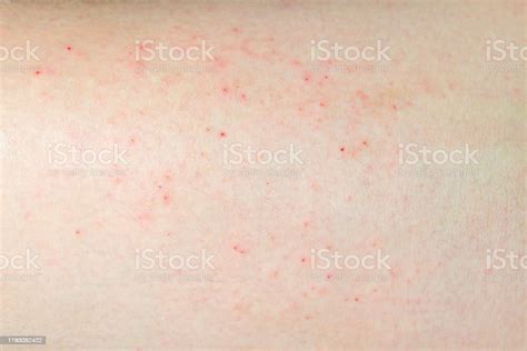 Allergic Rash Also Called Eczema Or Atopic Dermatitis Stock Photo