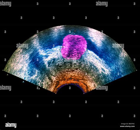 Prostate Tumour Coloured Ultrasound Scan Of A Section Through The