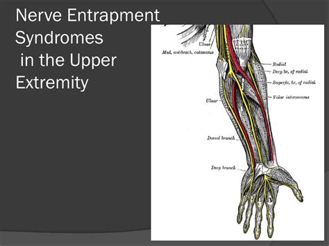 Upper Extremity Nerve Entrapments