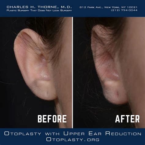 Otoplasty With Ear Reduction Plastic Surgery Ear Plastic Surgery