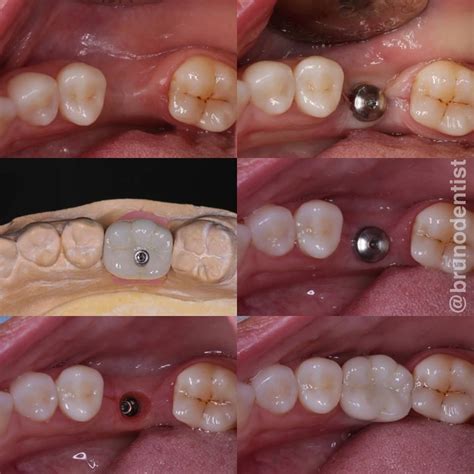 Replacing Missing Molar Tooth With Dental Implant And Zirconia Crown