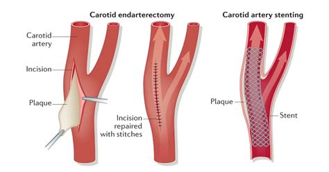 Carotid Endarterectomy Procedure