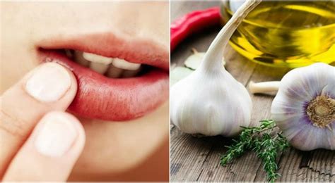 7 Home Remedies For Lip Infection