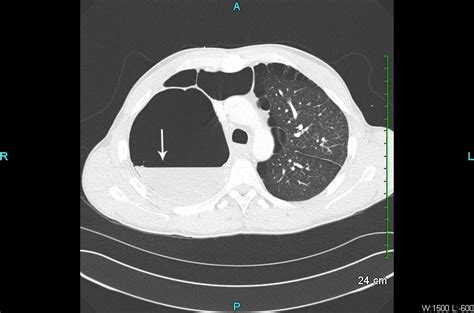 Bullous Lung Disease The Western Journal Of Emergency Medicine