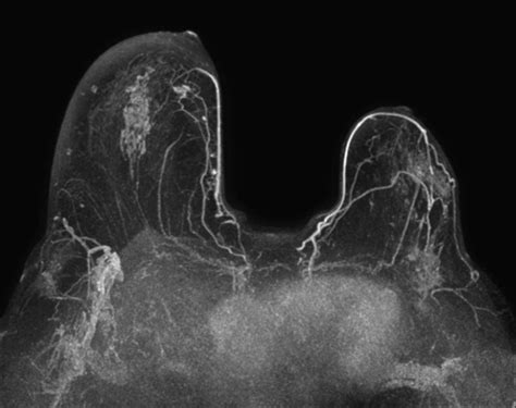 A Rare Case Of A Benign Breast Lesion Eurorad