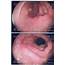 Endoscopic Image Of Duodenal Ulcer In A Patient With Chronic  Download