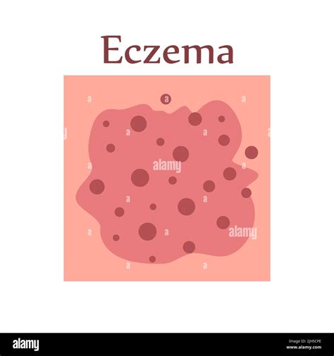Eczema On Human Skin Dermatological Disease The Symptom Is Itching