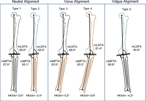 The Five Common Types Of Normal Coronal Limb Alignment In A Taiwanese